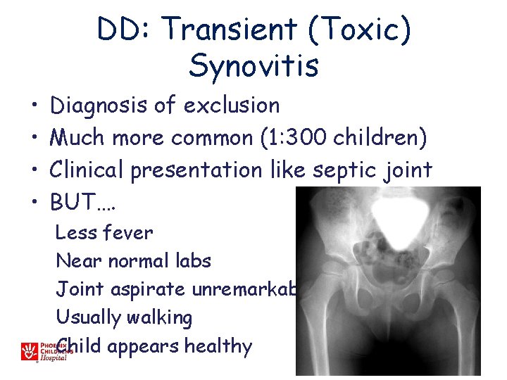 DD: Transient (Toxic) Synovitis • • Diagnosis of exclusion Much more common (1: 300