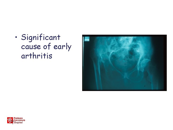  • Significant cause of early arthritis 39 