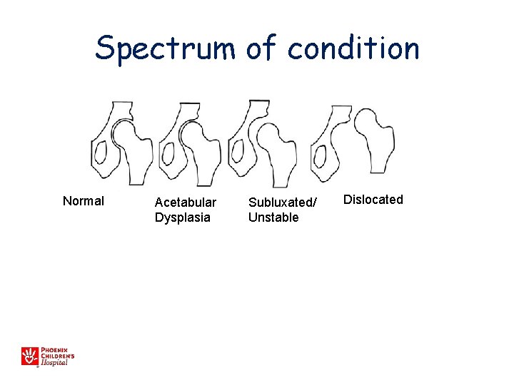 Spectrum of condition Normal Acetabular Dysplasia Subluxated/ Unstable Dislocated 
