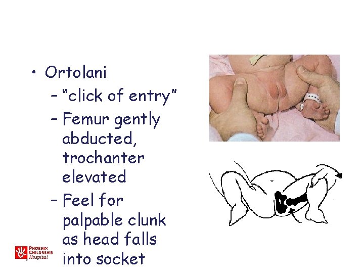  • Ortolani – “click of entry” – Femur gently abducted, trochanter elevated –