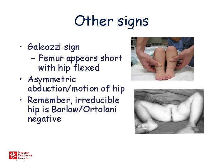 Other signs • Galeazzi sign – Femur appears short with hip flexed • Asymmetric