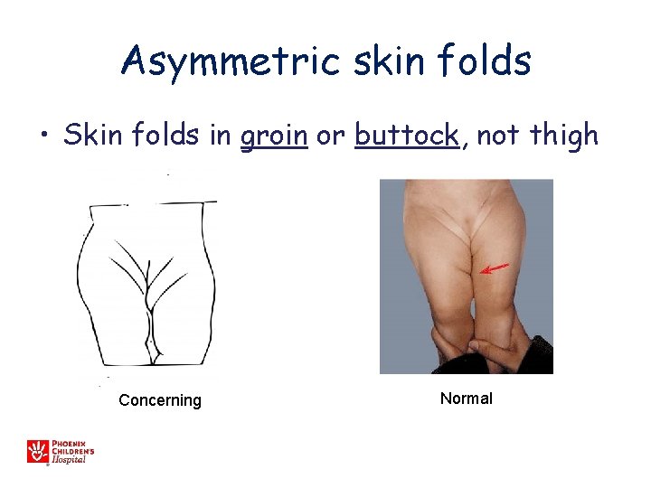 Asymmetric skin folds • Skin folds in groin or buttock, not thigh Concerning Normal