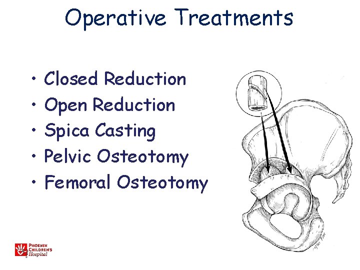 Operative Treatments • • • 52 Closed Reduction Open Reduction Spica Casting Pelvic Osteotomy
