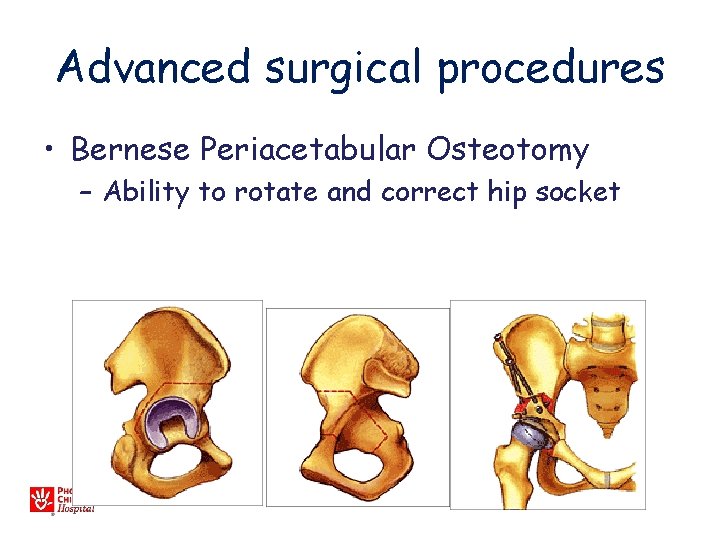 Advanced surgical procedures • Bernese Periacetabular Osteotomy – Ability to rotate and correct hip