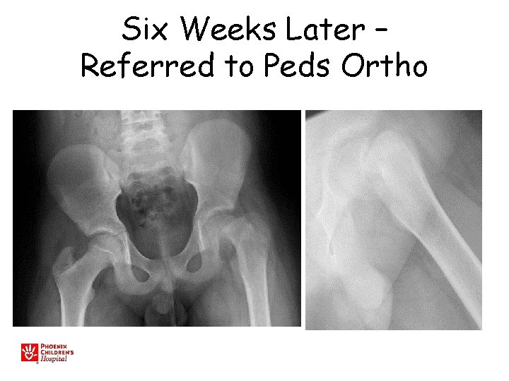 Six Weeks Later – Referred to Peds Ortho 