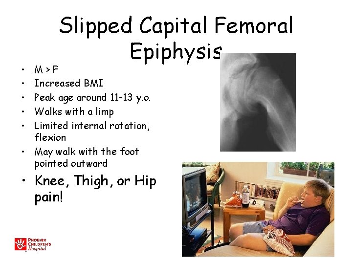  • • • Slipped Capital Femoral Epiphysis M>F Increased BMI Peak age around