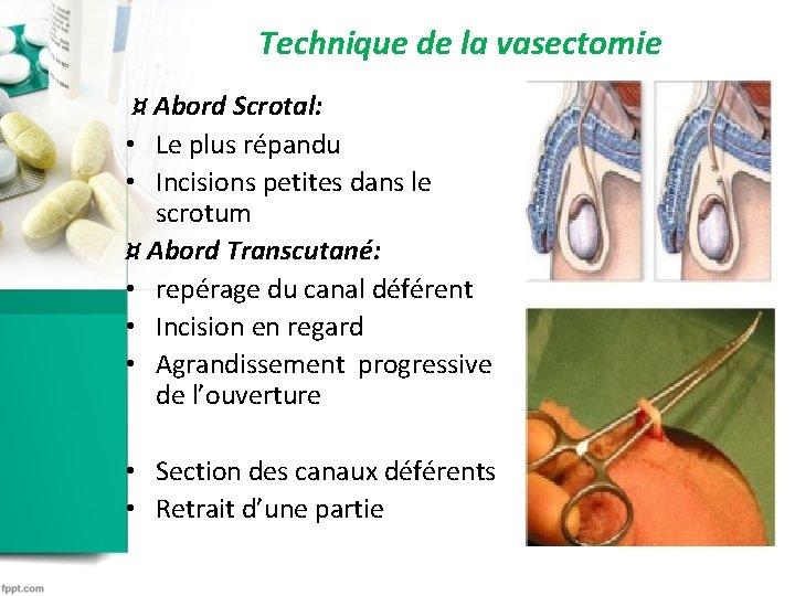 Technique de la vasectomie ¤ Abord Scrotal: • Le plus répandu • Incisions petites Technique de la vasectomie ¤ Abord Scrotal: • Le plus répandu • Incisions petites