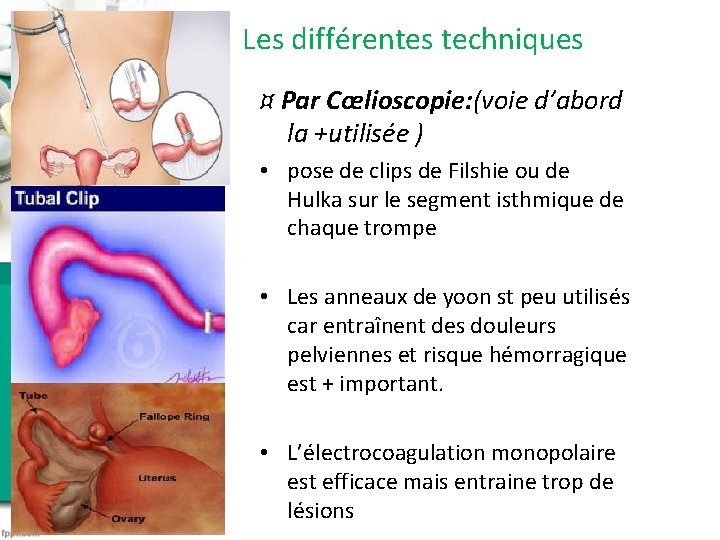 Les différentes techniques ¤ Par Cœlioscopie: (voie d’abord la +utilisée ) • pose de Les différentes techniques ¤ Par Cœlioscopie: (voie d’abord la +utilisée ) • pose de