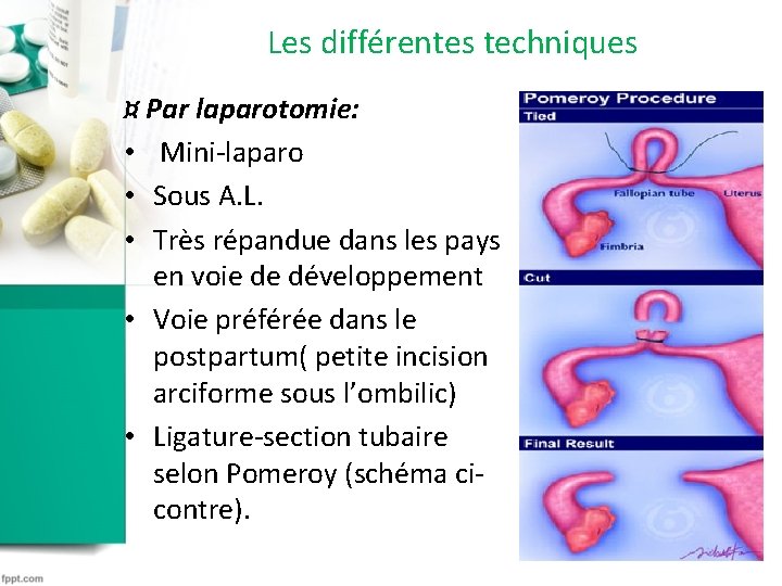 Les différentes techniques ¤ Par laparotomie: • Mini-laparo • Sous A. L. • Très Les différentes techniques ¤ Par laparotomie: • Mini-laparo • Sous A. L. • Très