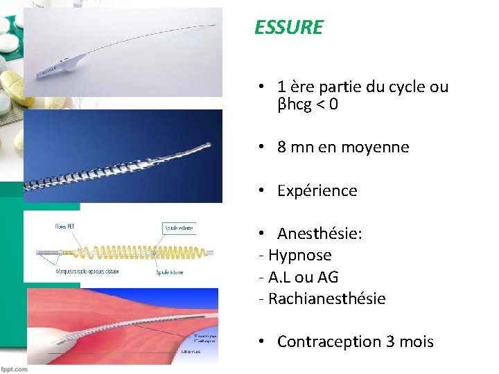 ESSURE • 1 ère partie du cycle ou βhcg < 0 • 8 mn ESSURE • 1 ère partie du cycle ou βhcg < 0 • 8 mn