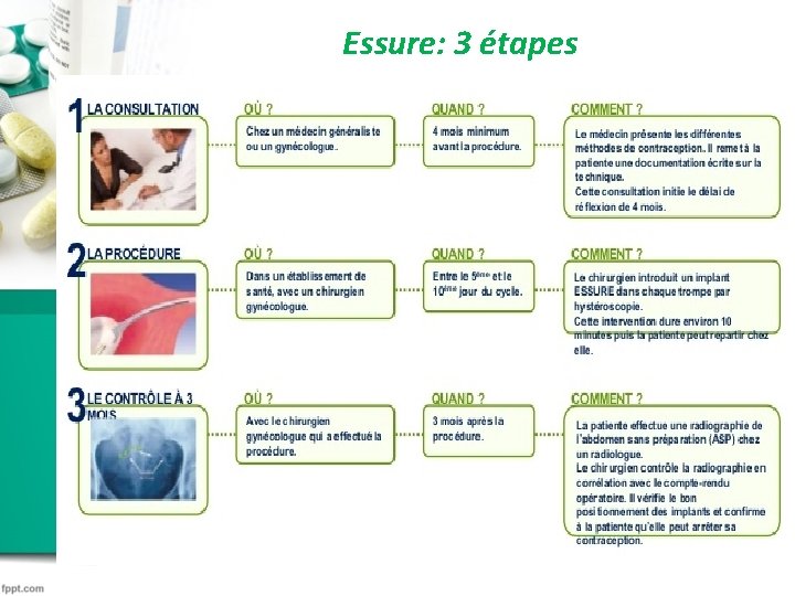 Essure: 3 étapes Essure: 3 étapes