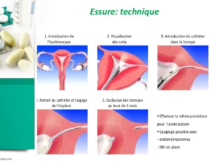 Essure: technique Essure: technique