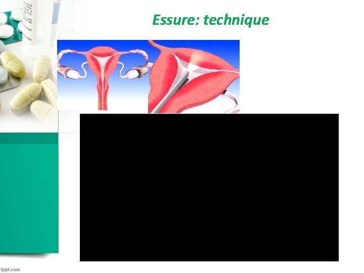 Essure: technique Essure: technique