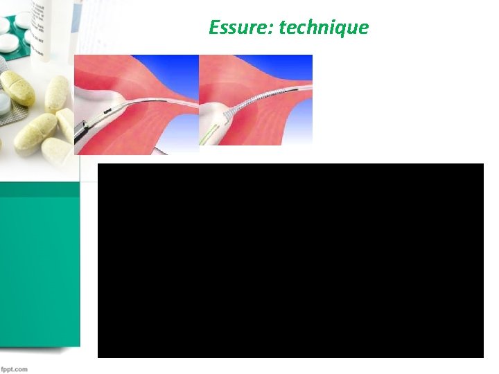 Essure: technique Essure: technique