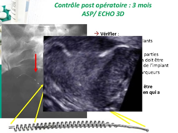 Contrôle post opératoire : 3 mois ASP/ ECHO 3 D Vérifier : • La Contrôle post opératoire : 3 mois ASP/ ECHO 3 D Vérifier : • La
