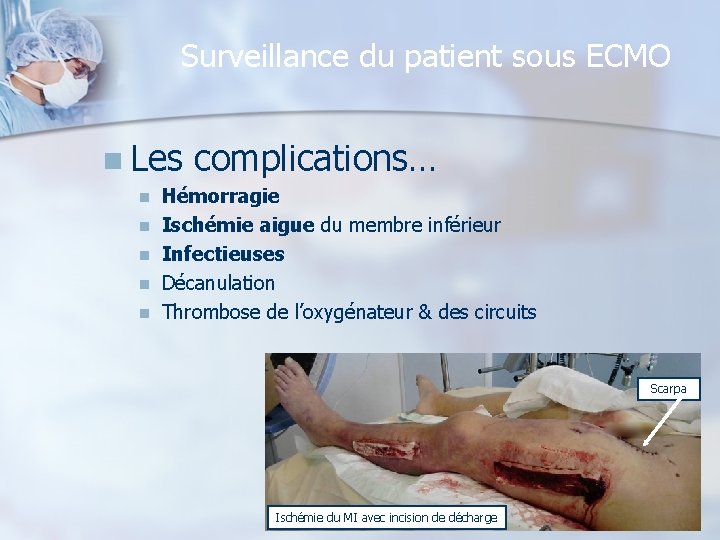 Surveillance du patient sous ECMO n Les n n n complications… Hémorragie Ischémie aigue