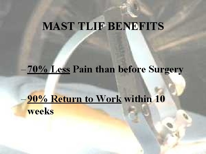 MAST TLIF BENEFITS – 70% Less Pain than before Surgery – 90% Return to