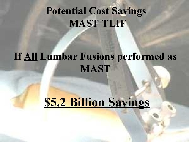 Potential Cost Savings MAST TLIF If All Lumbar Fusions performed as MAST $5. 2