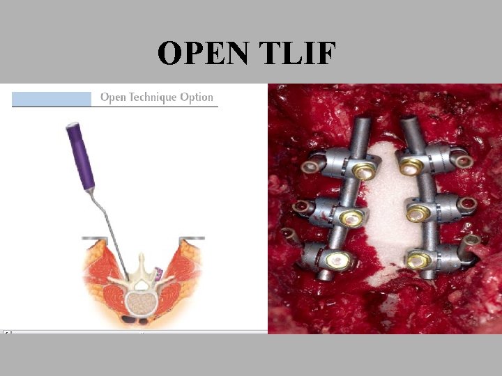 OPEN TLIF 