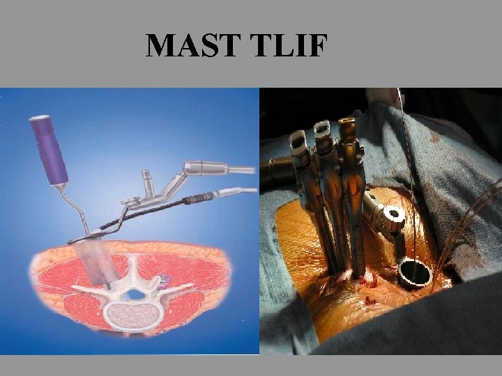 MAST TLIF 