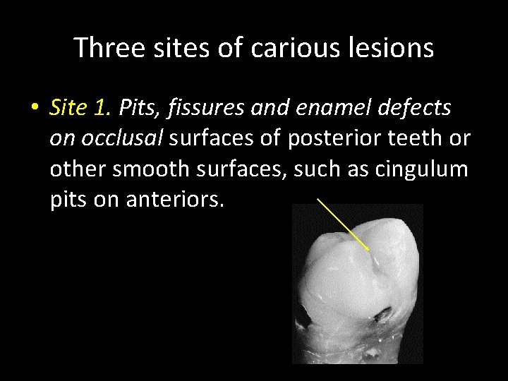 Three sites of carious lesions • Site 1. Pits, fissures and enamel defects on