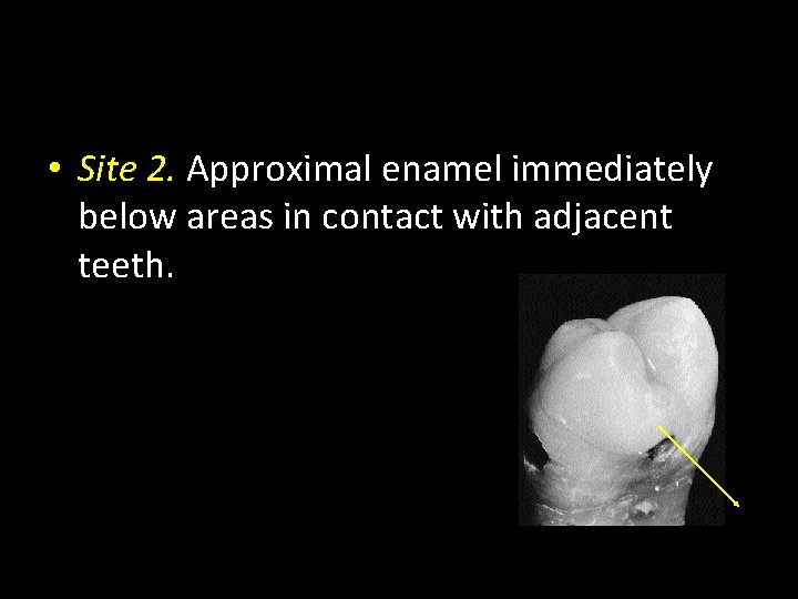  • Site 2. Approximal enamel immediately below areas in contact with adjacent teeth.