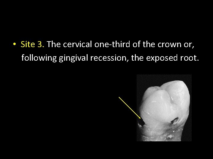  • Site 3. The cervical one-third of the crown or, following gingival recession,