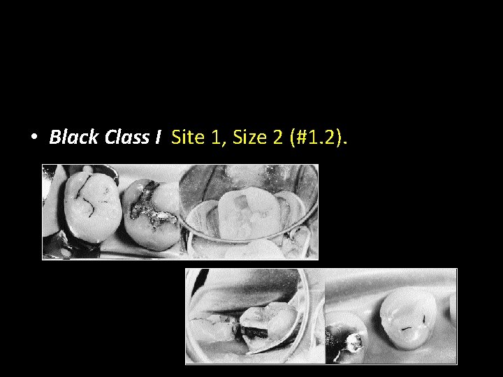  • Black Class I Site 1, Size 2 (#1. 2). 