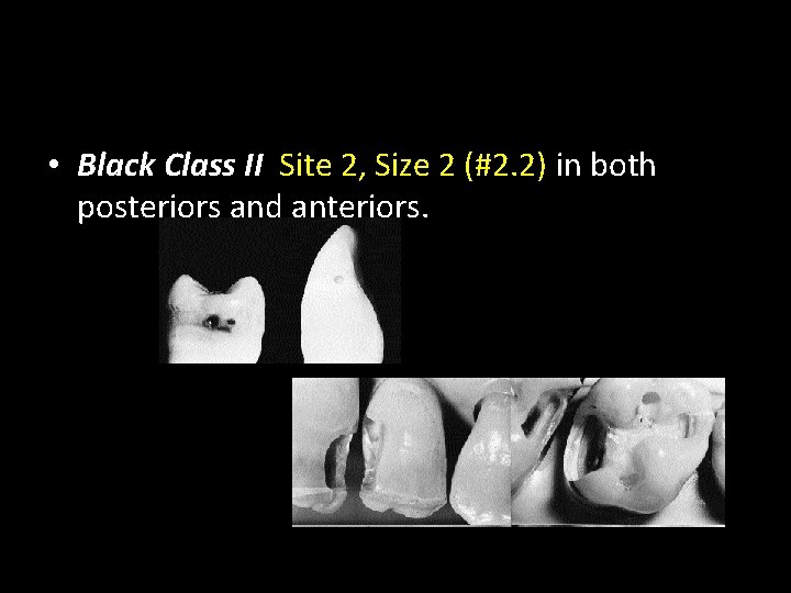  • Black Class II Site 2, Size 2 (#2. 2) in both posteriors