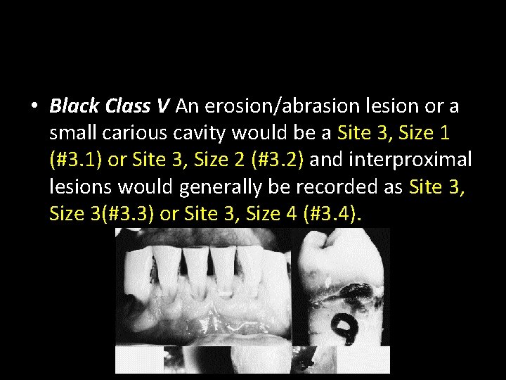  • Black Class V An erosion/abrasion lesion or a small carious cavity would