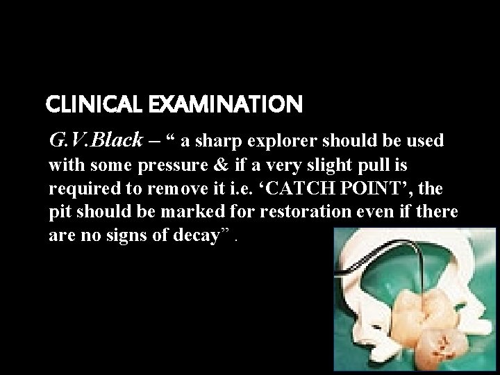 CLINICAL EXAMINATION G. V. Black – “ a sharp explorer should be used with