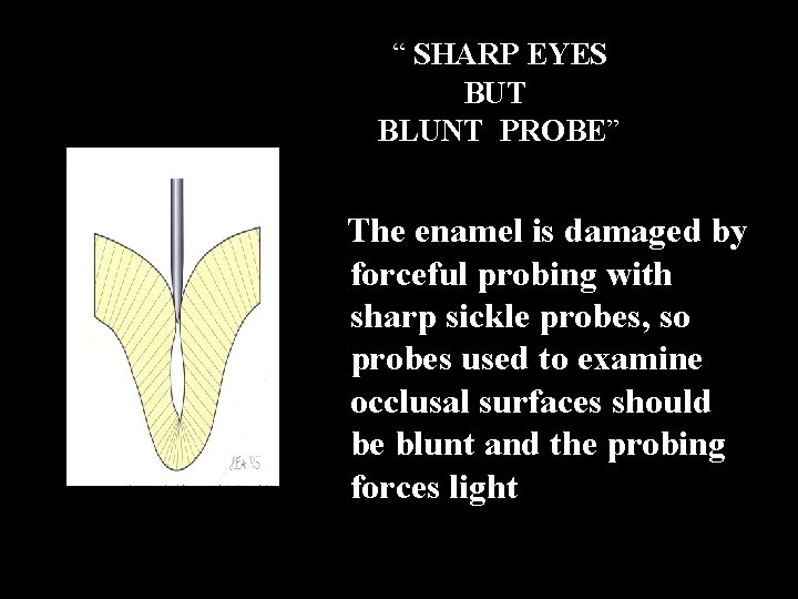 “ SHARP EYES BUT BLUNT PROBE” The enamel is damaged by forceful probing with