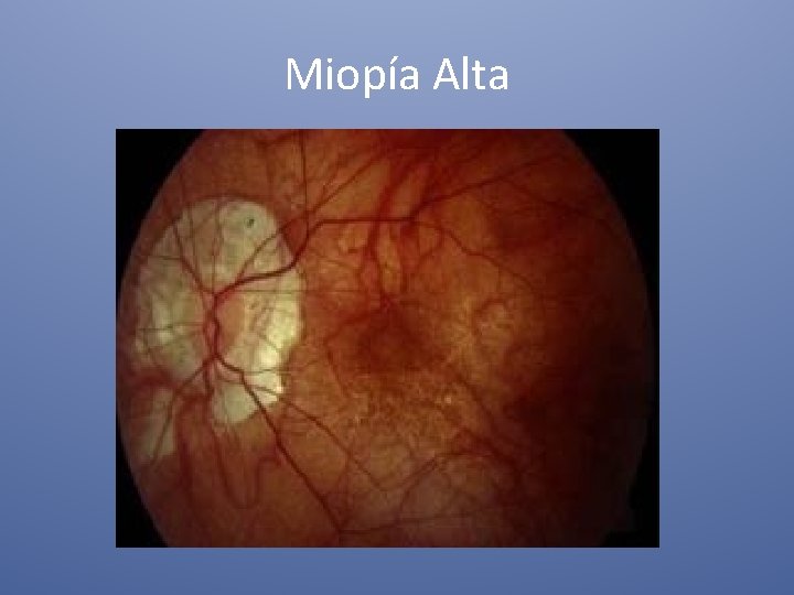 Miopía Alta 