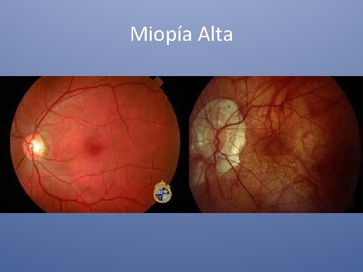 Miopía Alta 