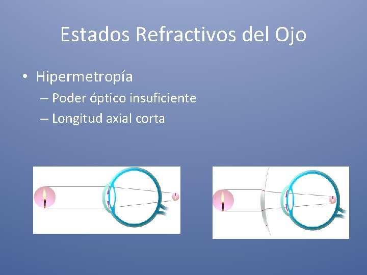 Estados Refractivos del Ojo • Hipermetropía – Poder óptico insuficiente – Longitud axial corta