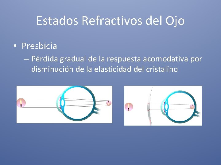 Estados Refractivos del Ojo • Presbicia – Pérdida gradual de la respuesta acomodativa por