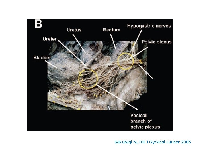 Sakuragi N, Int J Gynecol cancer 2005 