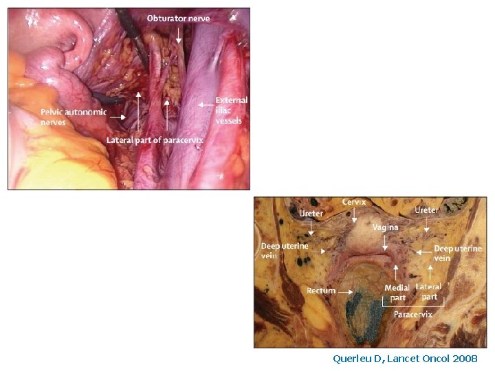 Querleu D, Lancet Oncol 2008 