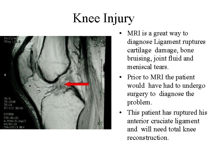 Knee Injury • MRI is a great way to diagnose Ligament ruptures cartilage damage,