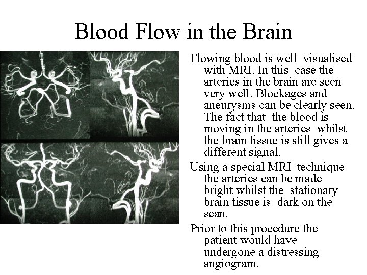 Blood Flow in the Brain Flowing blood is well visualised with MRI. In this