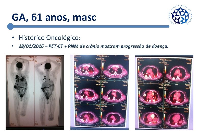 GA, 61 anos, masc • Histórico Oncológico: • 28/01/2016 – PET-CT + RNM de