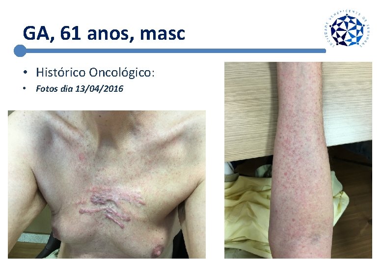 GA, 61 anos, masc • Histórico Oncológico: • Fotos dia 13/04/2016 