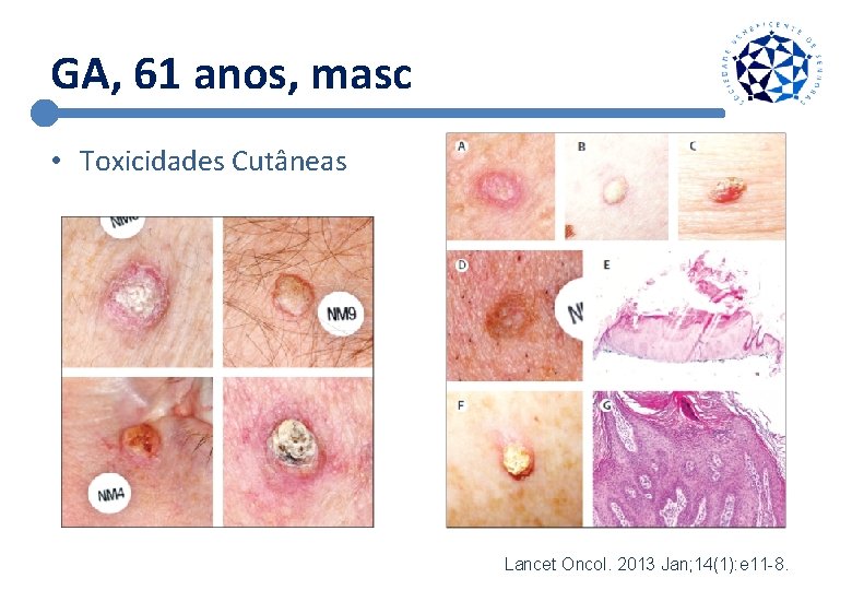 GA, 61 anos, masc • Toxicidades Cutâneas Lancet Oncol. 2013 Jan; 14(1): e 11