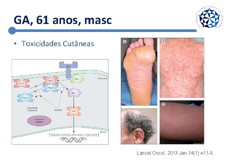GA, 61 anos, masc • Toxicidades Cutâneas Lancet Oncol. 2013 Jan; 14(1): e 11