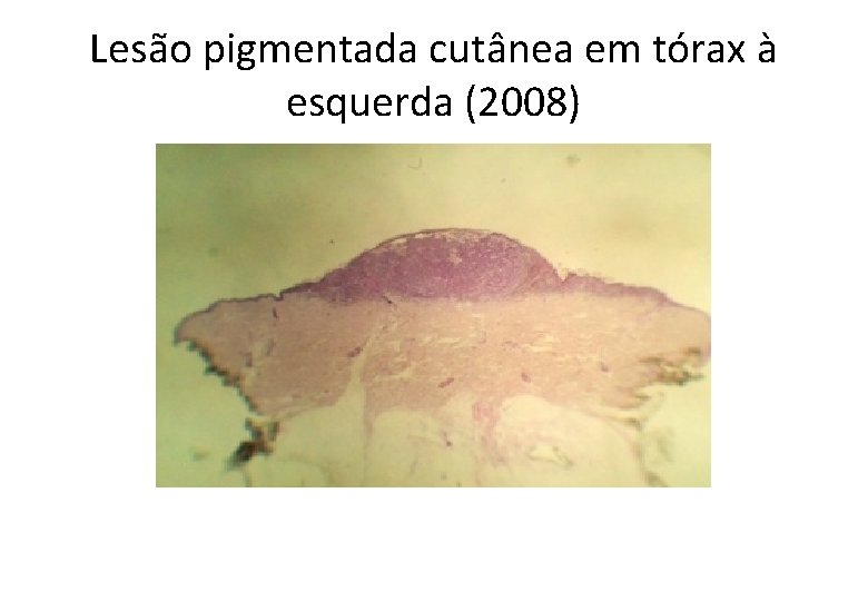 Lesão pigmentada cutânea em tórax à esquerda (2008) 