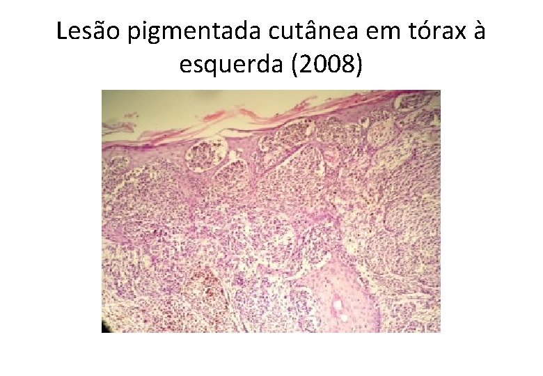 Lesão pigmentada cutânea em tórax à esquerda (2008) 