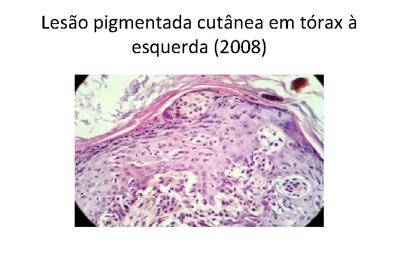 Lesão pigmentada cutânea em tórax à esquerda (2008) 