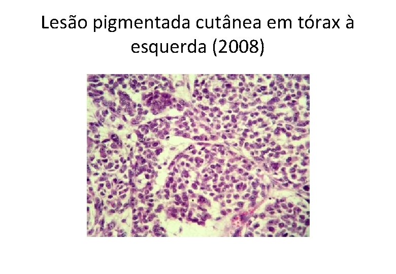 Lesão pigmentada cutânea em tórax à esquerda (2008) 