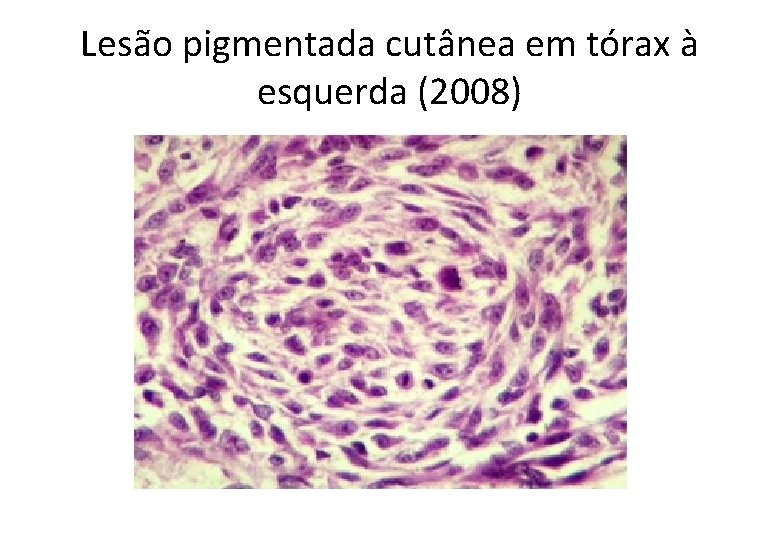 Lesão pigmentada cutânea em tórax à esquerda (2008) 