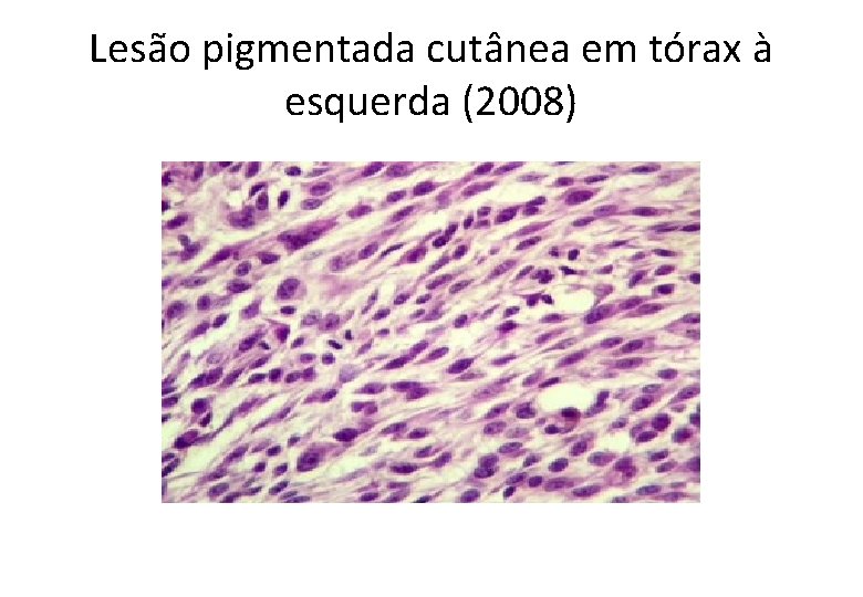 Lesão pigmentada cutânea em tórax à esquerda (2008) 